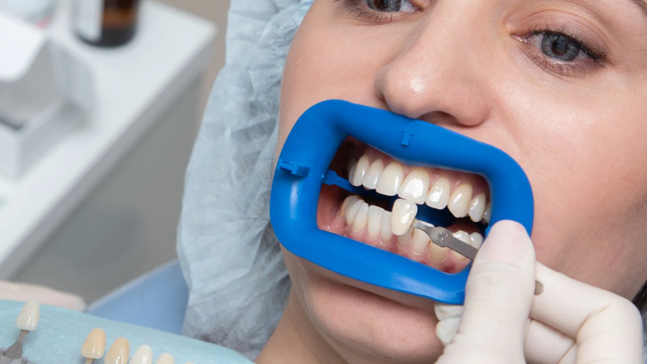 Estetică Dentară