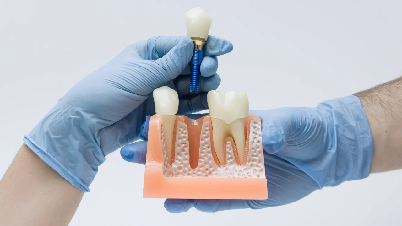 Implantologie Dentară